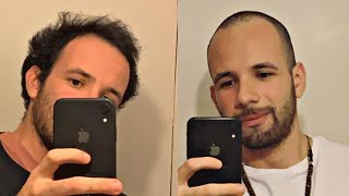 BALDING HAIR vs BUZZ CUT At 23  My Experience [upl. by Aneral520]