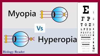 Difference Between Myopia and Hyperopia  Examples and Comparison Chart [upl. by Wilburt964]