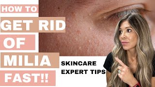 How to get rid of Milia FAST 2024 Smooth Skin Secrets Master Esthetician Milia Removal Tips [upl. by Asteria163]