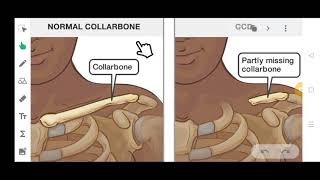 CLEIDOCRANIAL DYSPLASIA  IN JUST 5 MINUTES  SIMPLE AND EASY [upl. by Rehptsirhc647]