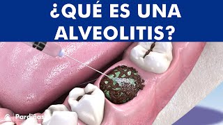 ALVEOLITIS DENTAL  Infección tras extracción de muela causas y tratamiento © [upl. by Irmina179]