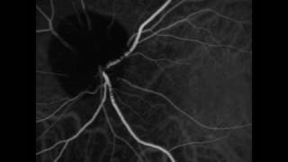 Ophthalmic Melanocytoma of the Optic Nerve [upl. by Gnat]