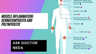 Muscle Inflammatory Disease DermatomyositisPolymyositis Diagnosis and Treatment [upl. by Elissa728]