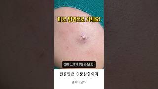 얼굴 점이 부풀었다 핀홀법 수술 피지낭종 표피낭종 피부과 성형외과 병원 nevus epidermal cyst surgery hospital seoul korea아문TV [upl. by Sydel351]