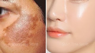 In 2 DAYSRemove DARK SPOTS  Apply Treatment on Your DARK SPOTS and See the Magic [upl. by Toy]