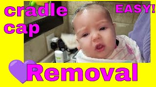 Revealing the Secret to Removing Cradle Cap in Seconds [upl. by Blodget]