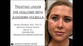 Treating Under Eye Hollows with Juvederm Volbella by Dr Agarwal [upl. by Liebman243]