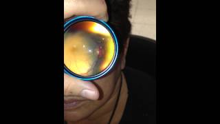 Inexpensive Telemedicine Fundoscopy performed using an Iphone and a 20D lens [upl. by Nollie]