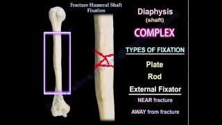 Humeral Shaft fracture Fixation  Everything You Need To Know  Dr Nabil Ebraheim [upl. by Templeton]