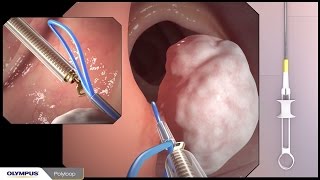 Colonoscopy with polypectomy procedure overview using Olympus devices [upl. by Eeltrebor530]