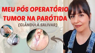 Meu pós operatório de tumor de parótida glândula salivar [upl. by Schreibe]