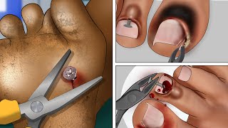 ASMR Animation Screw nail removal  Toenail Treatment [upl. by Canice]