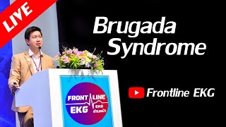 Live Brugada Syndrome โรคไหลตาย [upl. by Enogitna]