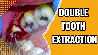 94 Live Extraction of Grossly Decayed Wisdom Teeth [upl. by Aicilet]