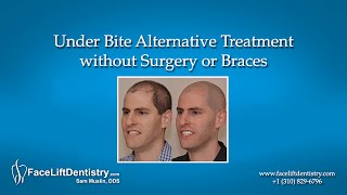 Underbite Alternative Treatment without Surgery or Braces [upl. by Amjan793]