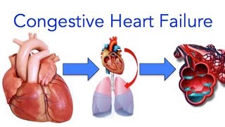 CONGESTIVE HEART FAILURE MNEMONIC [upl. by Htenaj]