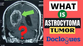 What is Astrocytoma Tumor [upl. by Llehsam]