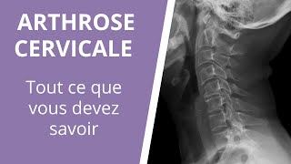 Tout ce que vous devez savoir sur larthrose cervicale  causes symptômes et traitements [upl. by Aurelia]