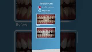 Opalescence™ Boost™ and Opalescence™ PF  Case Study [upl. by Towne]