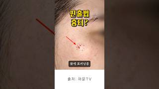 핀홀법 흉터 어떨까 얼굴 멍울 낭종 수술 피지 압출 피지낭종 표피낭종 지방종 수술 성형외과 병원 epidermal cyst surgery seoul korea아문TV [upl. by Sparkie84]