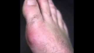 Pictures of Gout and Tophaceous Gout [upl. by Leibrag]