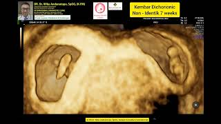 7 Weeks Dichorionic Twins [upl. by Ruddy966]