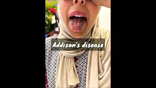 Addisons Disease Adrenal Insufficiency [upl. by Blaire]