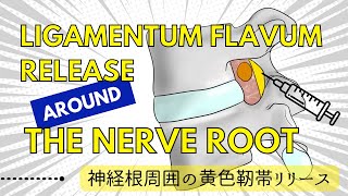 Ligamentum flavum release around the nerve root 神経根周囲の黄色靭帯リリース [upl. by Columbus915]