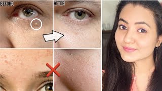 कितने भी मुश्किल MILIA मिलिया TINY BUMPS WHITE BUMPS हो इस Remedy से होगा 100 इलाज  100 Results [upl. by Arayt612]