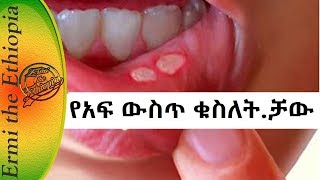 የአፍ ውስጥ ቁስለት ቻው Best Home Remedies For Mouth Ulcers [upl. by Ahsitan]