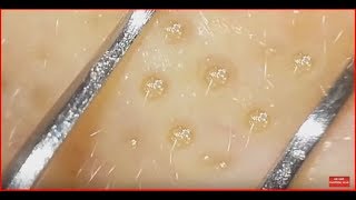 How to clean in depth clogged pores with clip curved tweezers [upl. by Sihtam850]