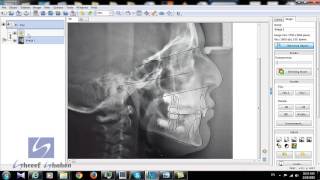 Digital cephalometry superimposition all steps [upl. by Bradlee345]