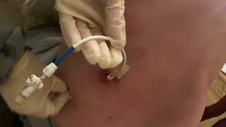 How to clean the area of nephrostomy or nephroureteral drain by Kathy [upl. by Ros]