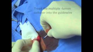 Femoral Vein  Central Venous Line Insertion [upl. by Nava]