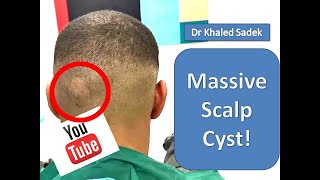 Massive cyst eruption LipomaCystcom Dr Khaled Sadek [upl. by Leonelle988]