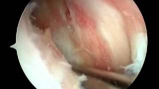 Knee Arthroscopy  Gout [upl. by Tennek353]