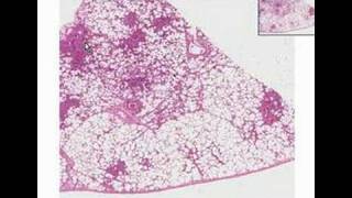 Histopathology LungBronchopneumonia [upl. by Groos641]