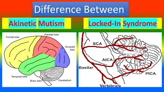 Difference between Akinetic Mutism and Lockin Syndrome [upl. by Hegarty]