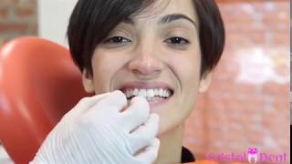 Applicazione Faccette Dentali  Torino [upl. by Yerffe719]