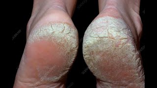 Palmoplantar Psoriasis Dos amp Donts  உள்ளங்கால் சொரியாசிஸ் சவால்  Dr Selvin [upl. by Luaped]