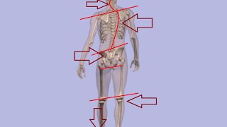 Back Pain Anterior Pelvic Tilt  best chiropractor uses Soft chiropractic adjustments 2016 [upl. by Ahslek]