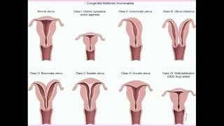 Congenital Uterine Abnormalities  CRASH Medical Review Series [upl. by Ahtibbat]