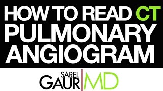 How to Read a CT Pulmonary Angiogram CTPA or PE Study [upl. by Jr745]