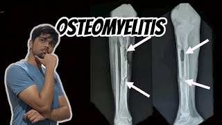 Osteomyelitis  Causes Pathogenesis Complications and Pathophysiology Bone Infection pathology [upl. by Hepsoj]