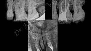 Management of Calcified Pulp Chamber amp Canals with Ultrasonics [upl. by Arvad293]