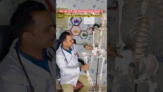 Leg Bones Fracture Healing Process trending viralvideo [upl. by Nired]