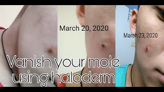 Vanish your mole  Using HALODERM [upl. by Notsa748]