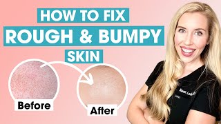 How To Fix Rough and Bumpy Skin  Keratosis Pilaris Affordable Skincare Routine [upl. by Ttirb]