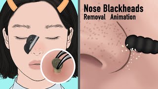 ASMR Satisfying Nose Blackheads Extracted Animation  removal of hair from a mole  Tingles [upl. by Cross]