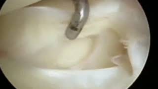 Popliteomeniscal Fascicle Tear Diagnosis and Operative Technique [upl. by Avron]